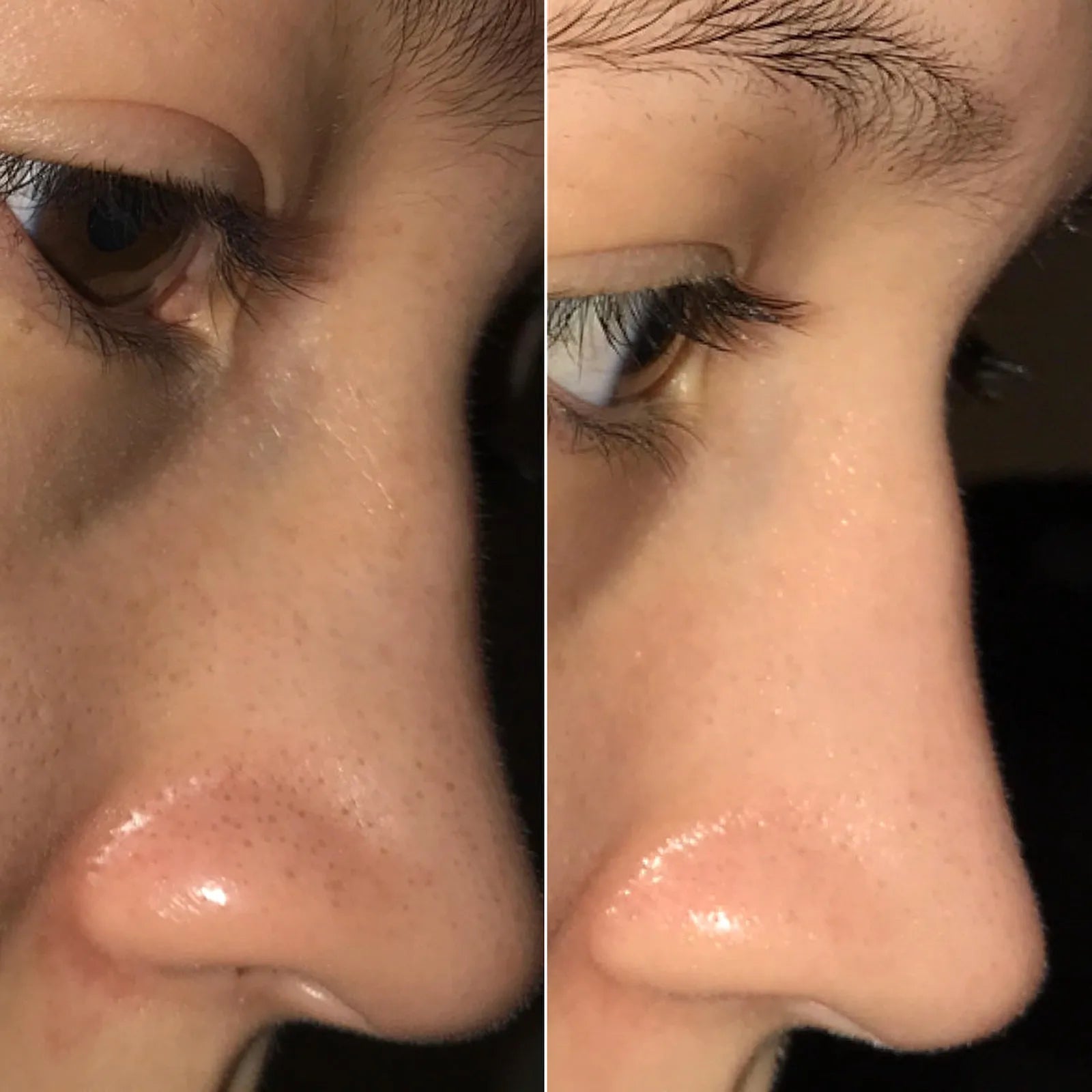 Visible before and after comparison of a clean nose area showing reduced blackheads and smoother, clearer skin
