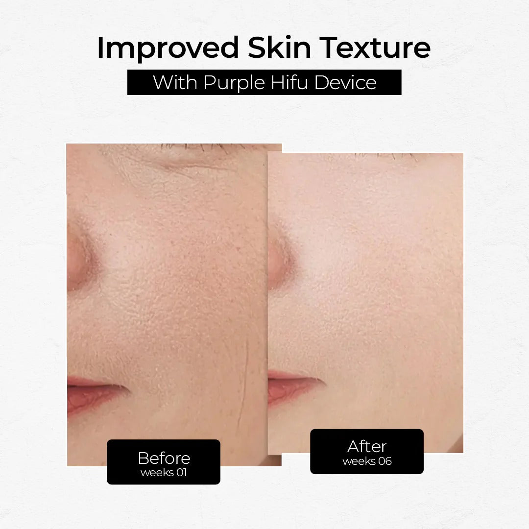 HIFU device treatment improving skin texture by tightening, lifting, and enhancing overall smoothness for a youthful appearance.