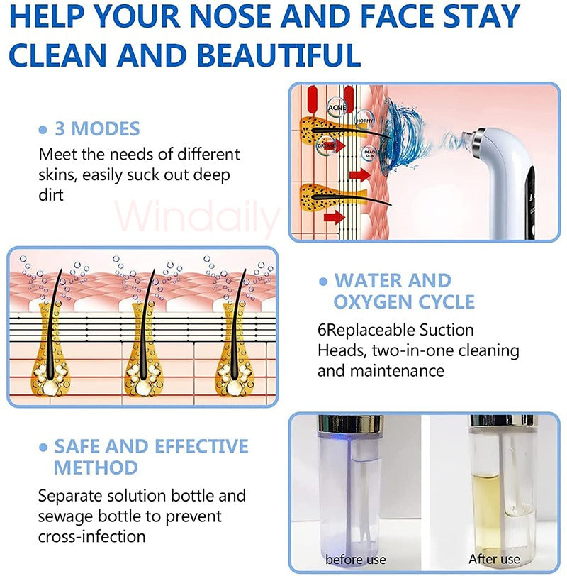 It’s Zara Balck Head Remover | water tank technology | Rechargeable Micro Bubble Face Vacuum Pore Cleanser Blackhead Remover With Water