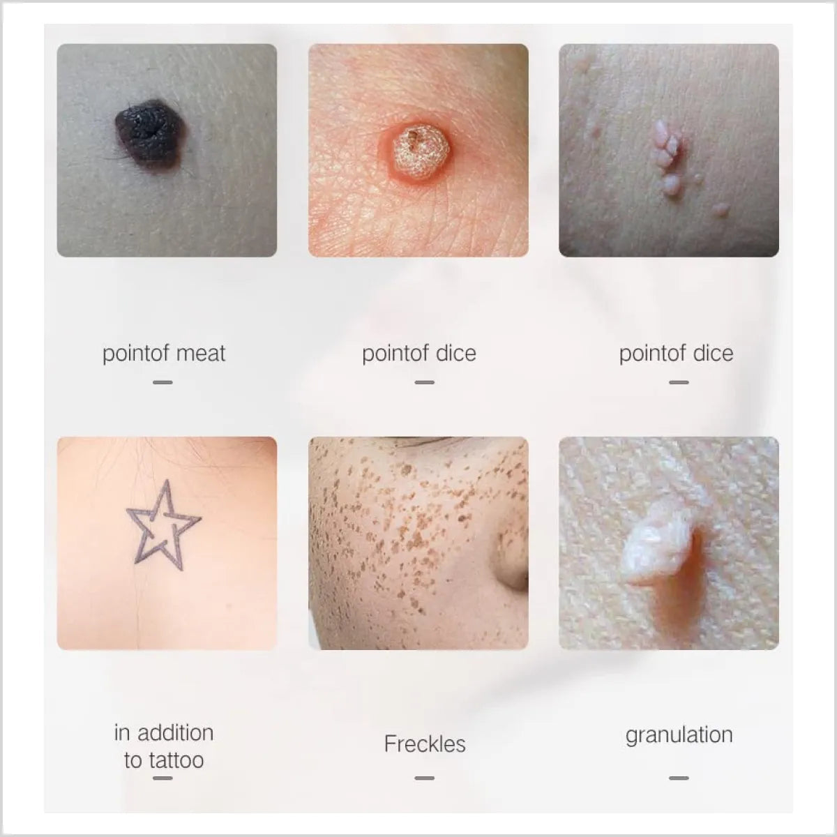 Laser Plasma Pen for Mole, Freckle, Wart & Skin Tag Removal – Pakistan