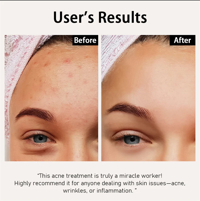 Visible before and after results of acne treatment, showing clearer, smoother skin with reduced blemishes and acne marks.