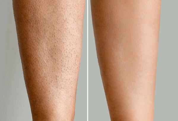 Comparison of two legs, one with visible skin texture and the other smooth, on a neutral background.