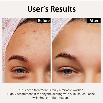 6 IN 1 Portable  High Frequency Facial Skin Wand