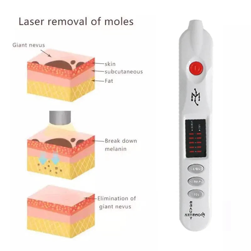 Laser mole removal process: breakdown of melanin, elimination of giant nevus, and smooth skin after treatment